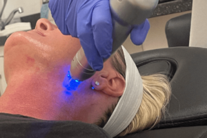 A lady having microneeding on her facee.